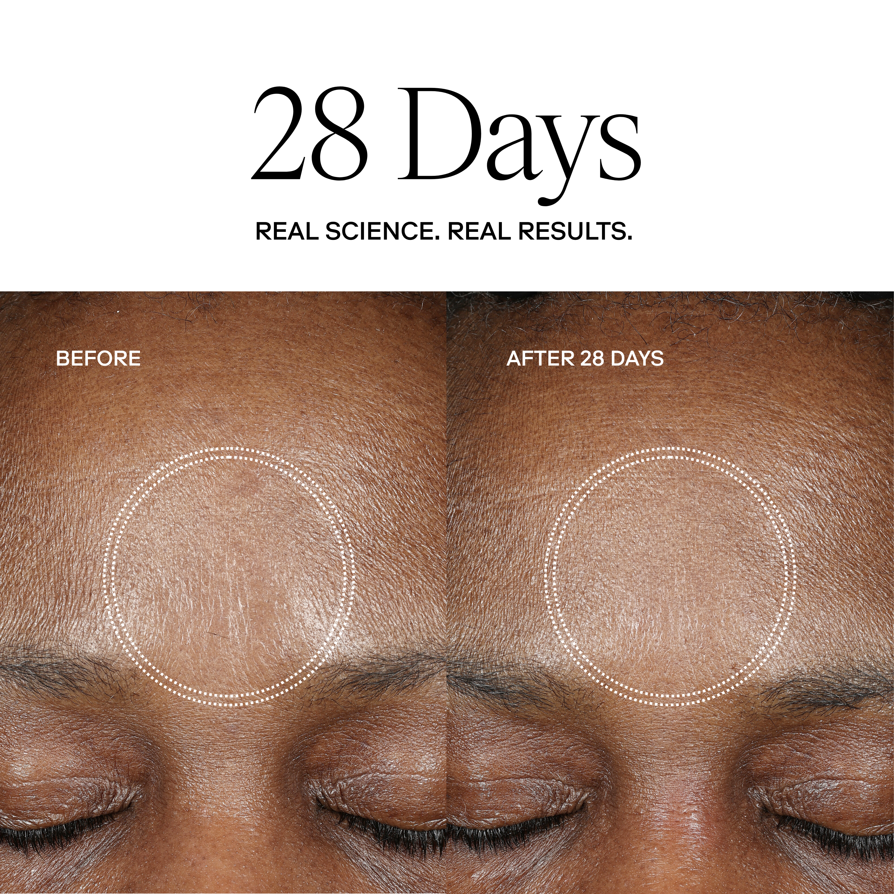 EXO H-SERUM™ Hyaluronic Acid Treatment / eXo³ Exosomes®