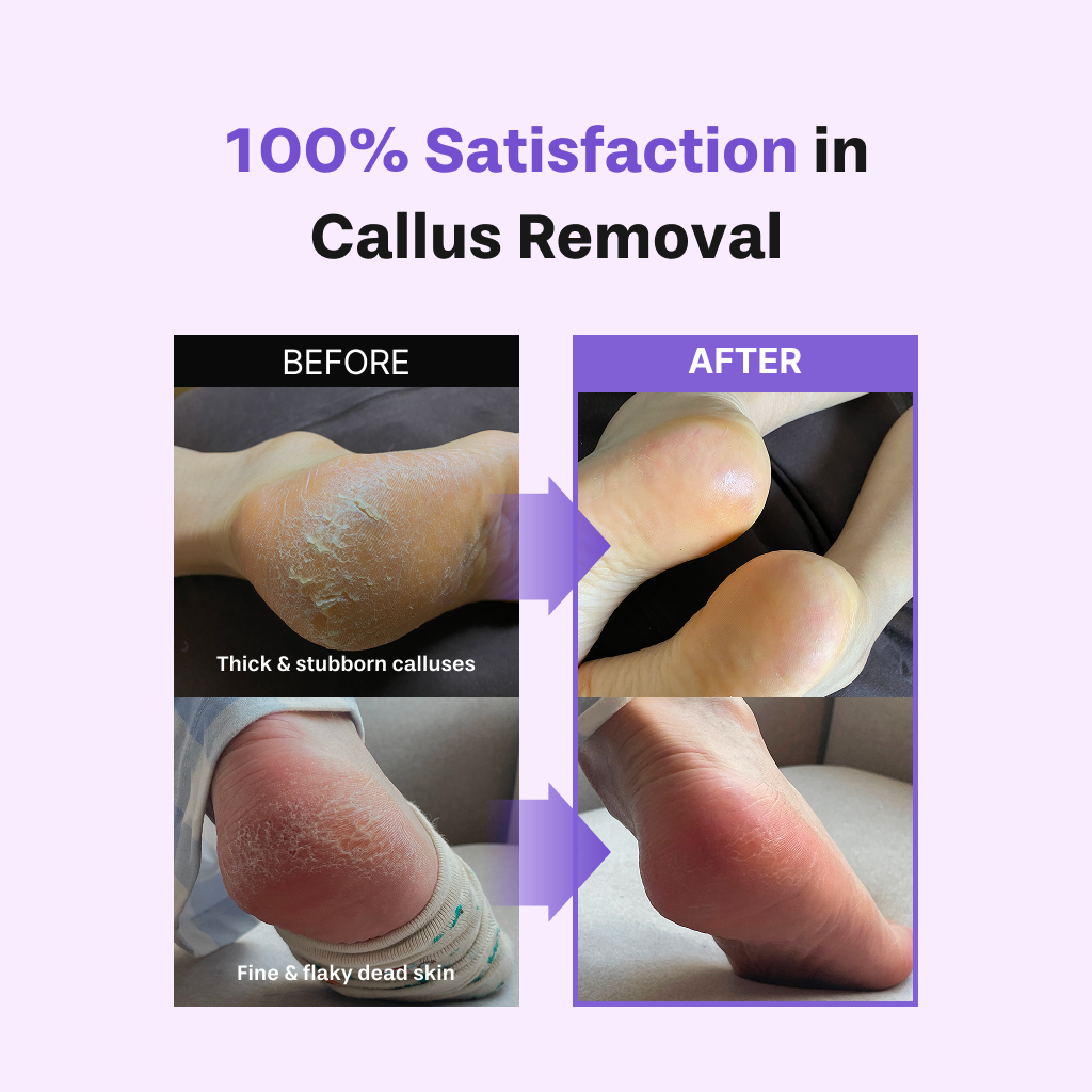 [BAREN] Foot Softener At-home Kit: Foot File & Callus Softener Spray